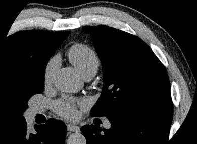 CT Coronary