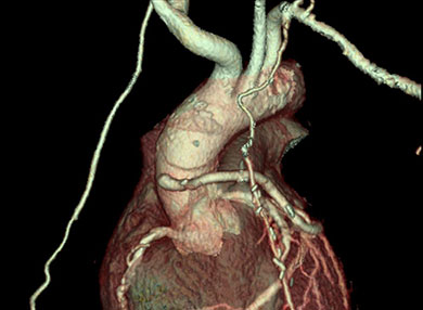 Angiogram