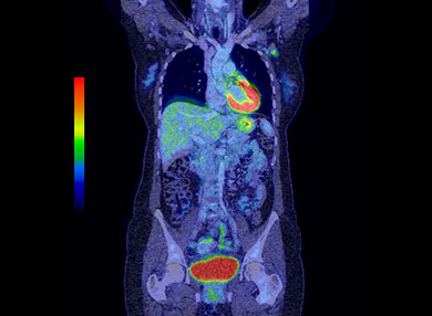 PET scan