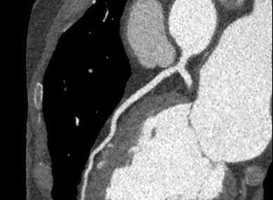 Angiogram