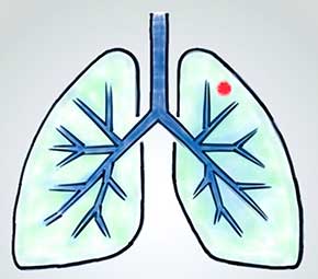 Early Lung Cancer Detection (ELUCiD) program